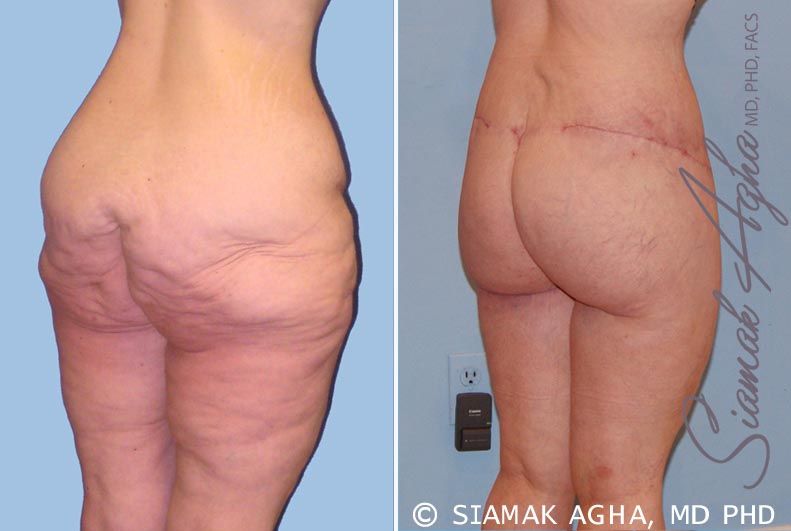 Spiral Thigh Lift Before & After