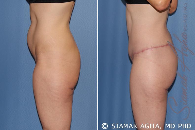 Spiral Thigh Lift Before & After