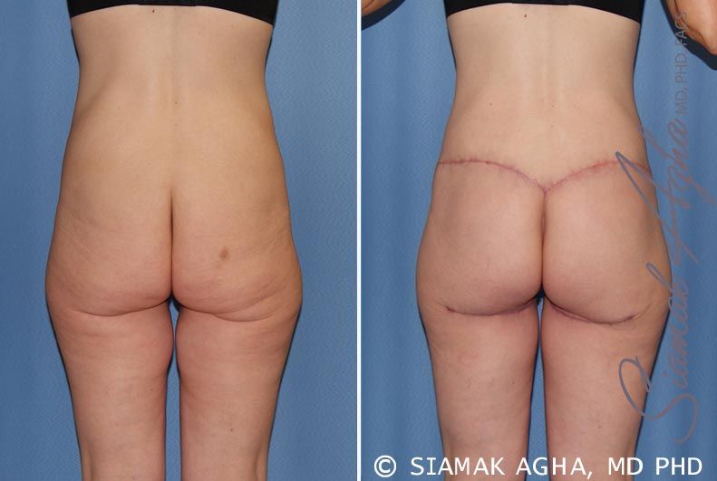 Spiral Thigh Lift Before & After