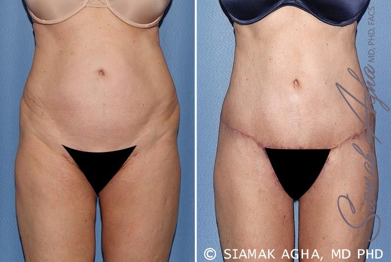 Spiral Thigh Lift Before & After