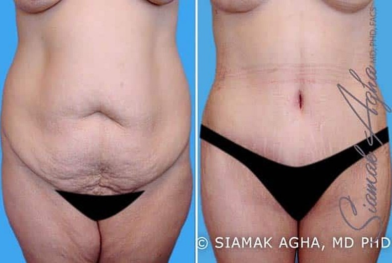 Spiral Thigh Lift Before & After