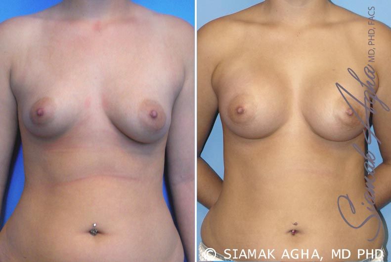 Breast Asymmetry Before & After