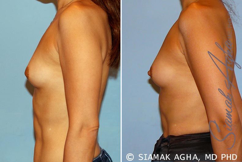Breast Asymmetry Before & After