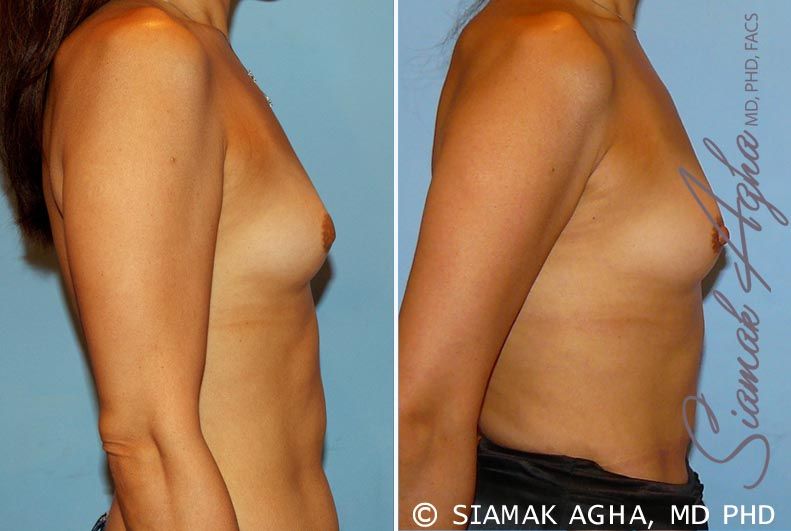 Breast Asymmetry Before & After