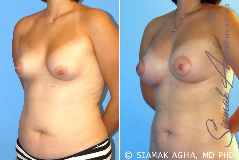 Breast Asymmetry Before & After