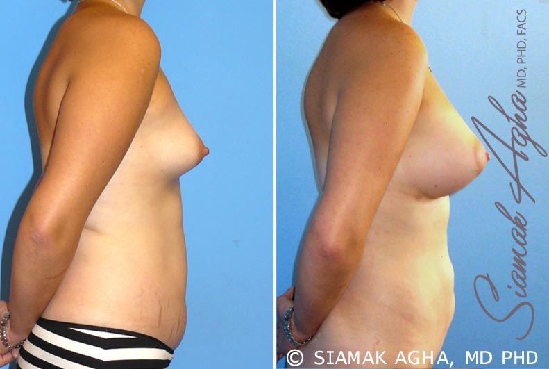 Breast Asymmetry Before & After