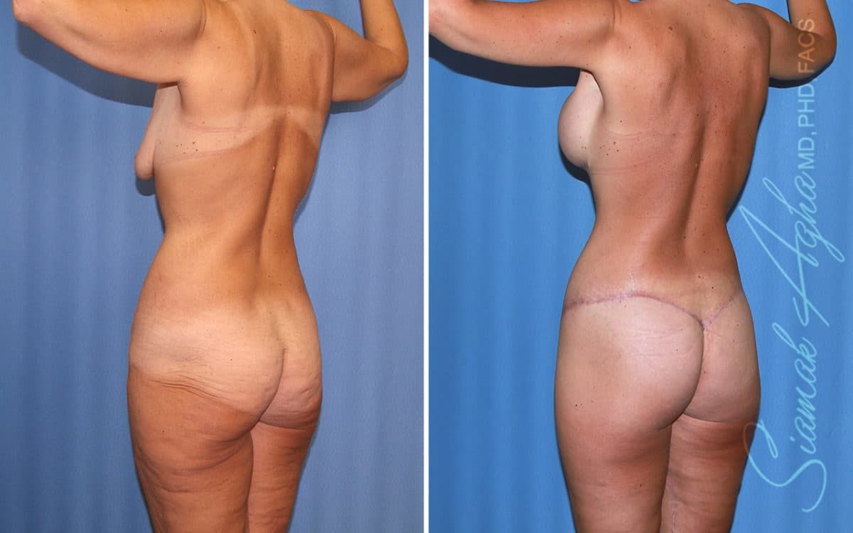 Buttock Reshaping After Weight Loss Before & After