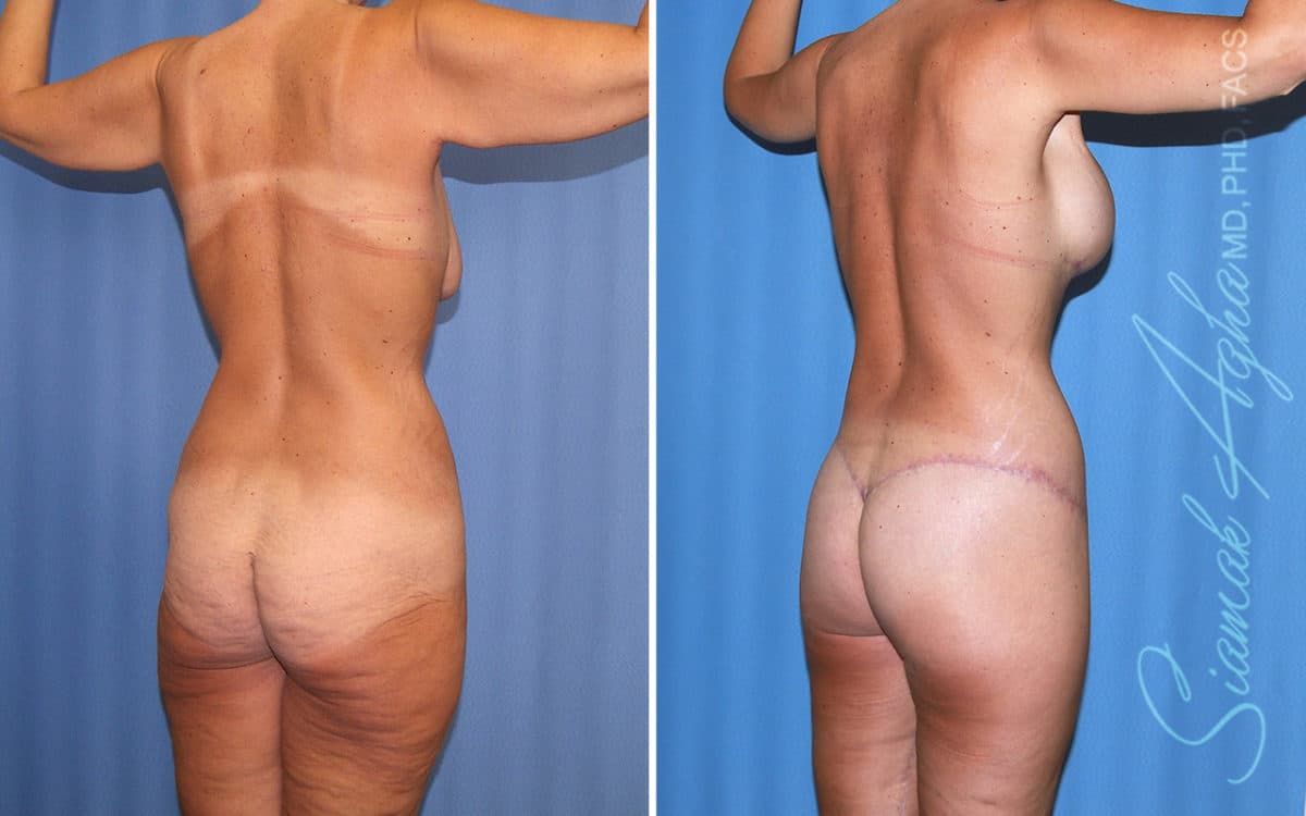 Buttock Reshaping After Weight Loss Before & After
