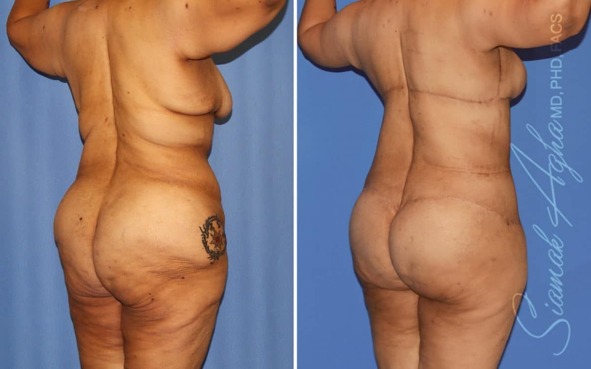 Buttock Reshaping After Weight Loss Before & After