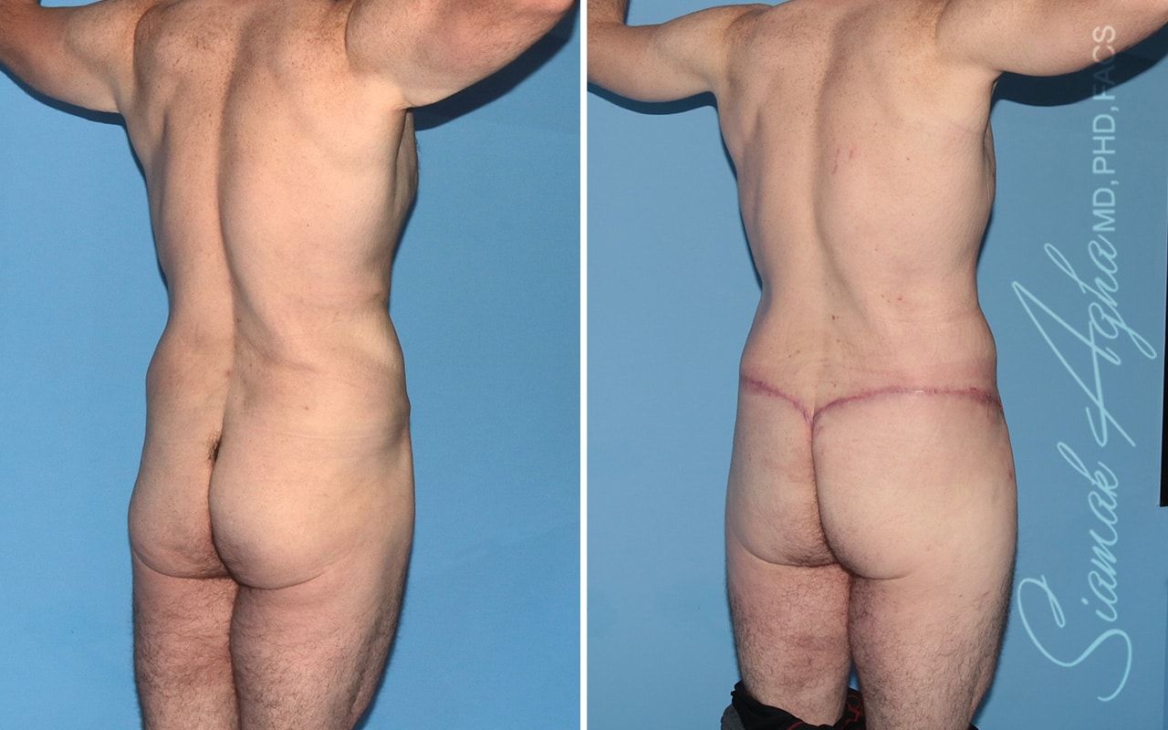 Buttock Reshaping After Weight Loss Before & After