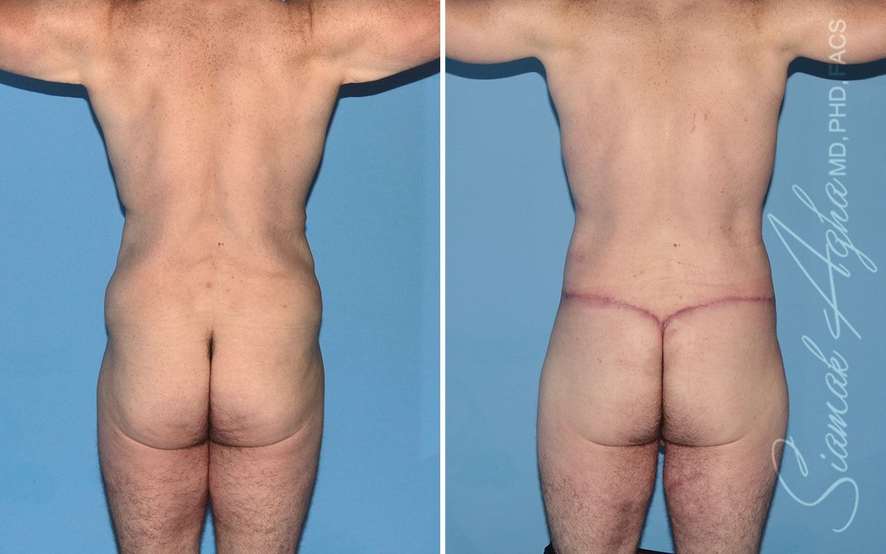 Buttock Reshaping After Weight Loss Before & After