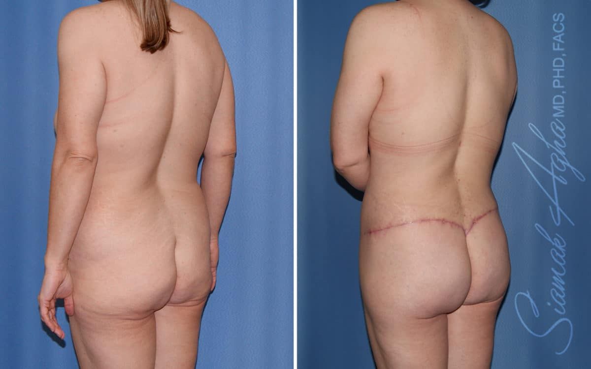 Buttock Reshaping After Weight Loss Before & After