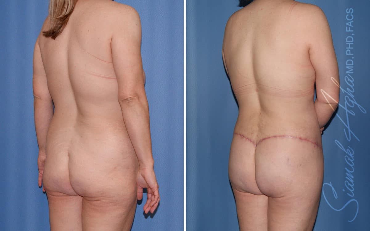Buttock Reshaping After Weight Loss Before & After
