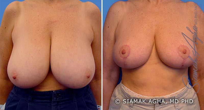 Breast Reduction Before & After