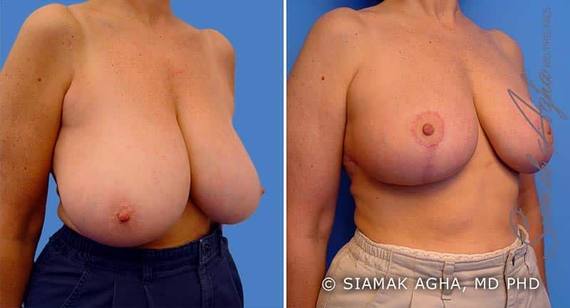 Breast Reduction Before & After