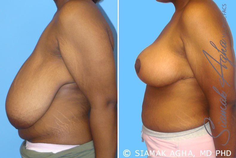 Breast Reduction Before & After