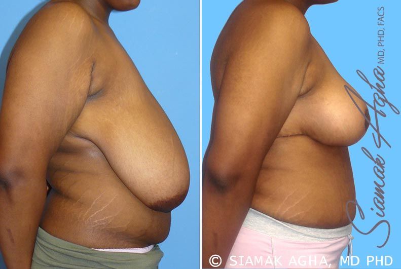 Breast Reduction Before & After