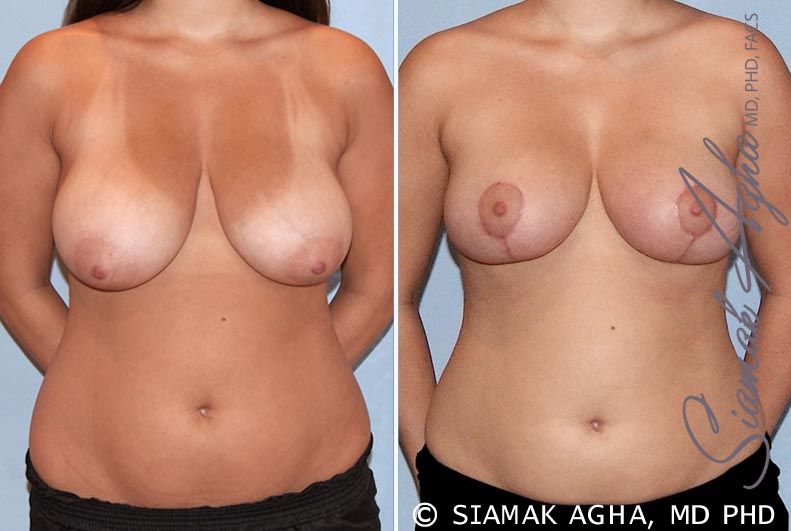 Breast Reduction Before & After