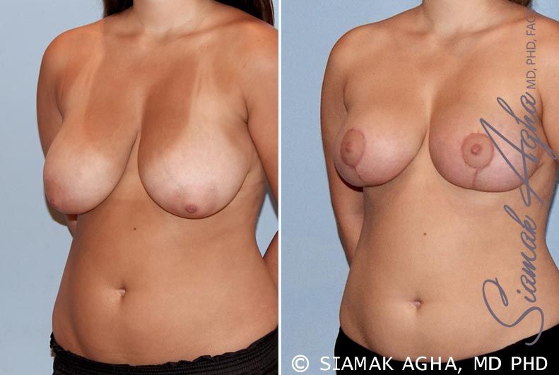 Breast Reduction Before & After