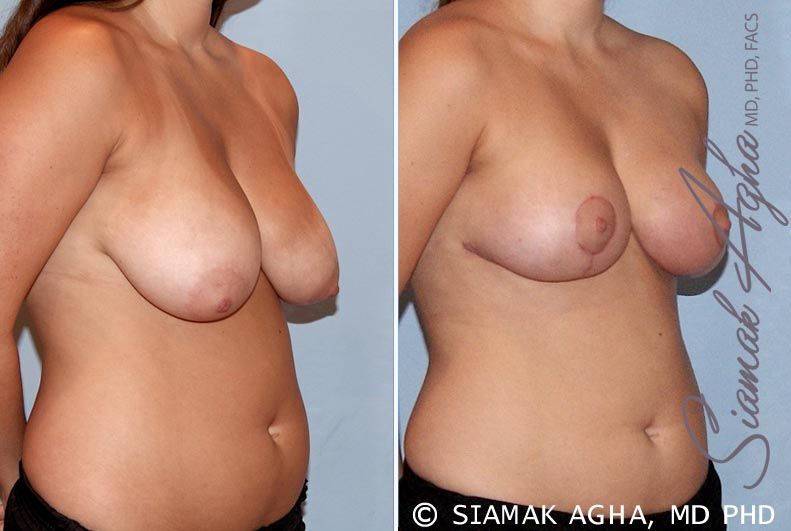 Breast Reduction Before & After