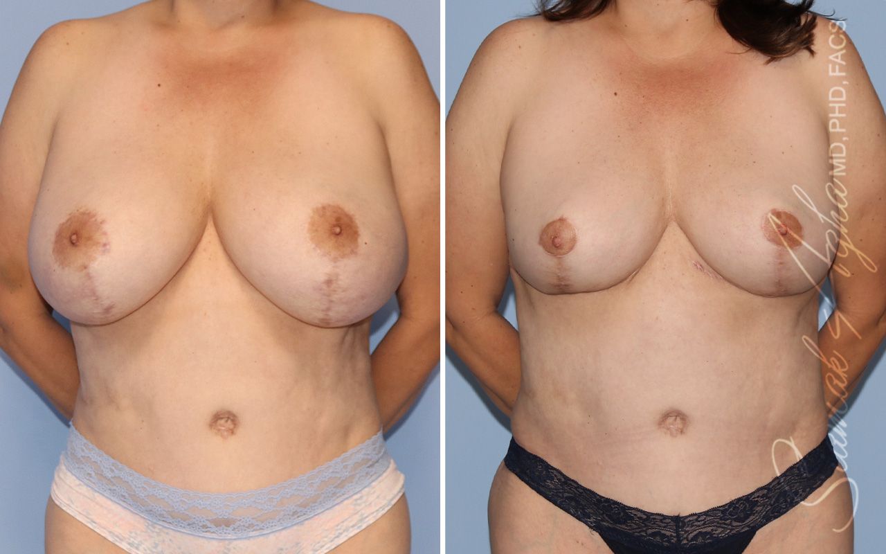 Breast Reduction Before & After