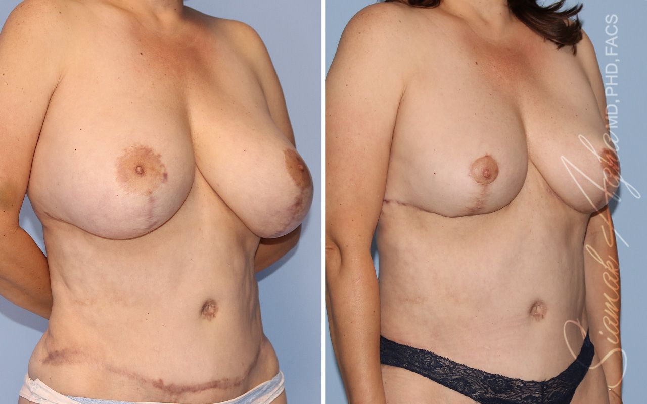 Breast Reduction Before & After