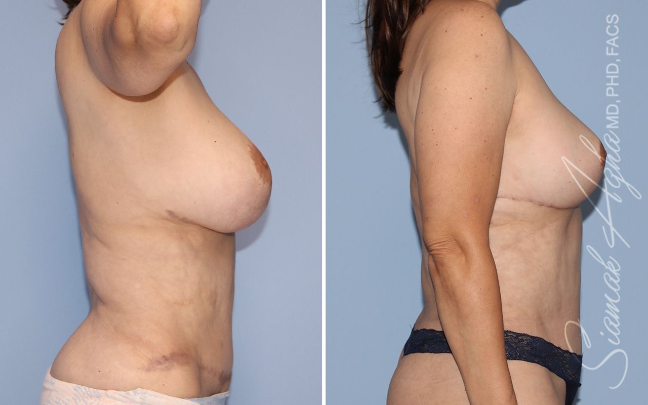 Breast Reduction Before & After