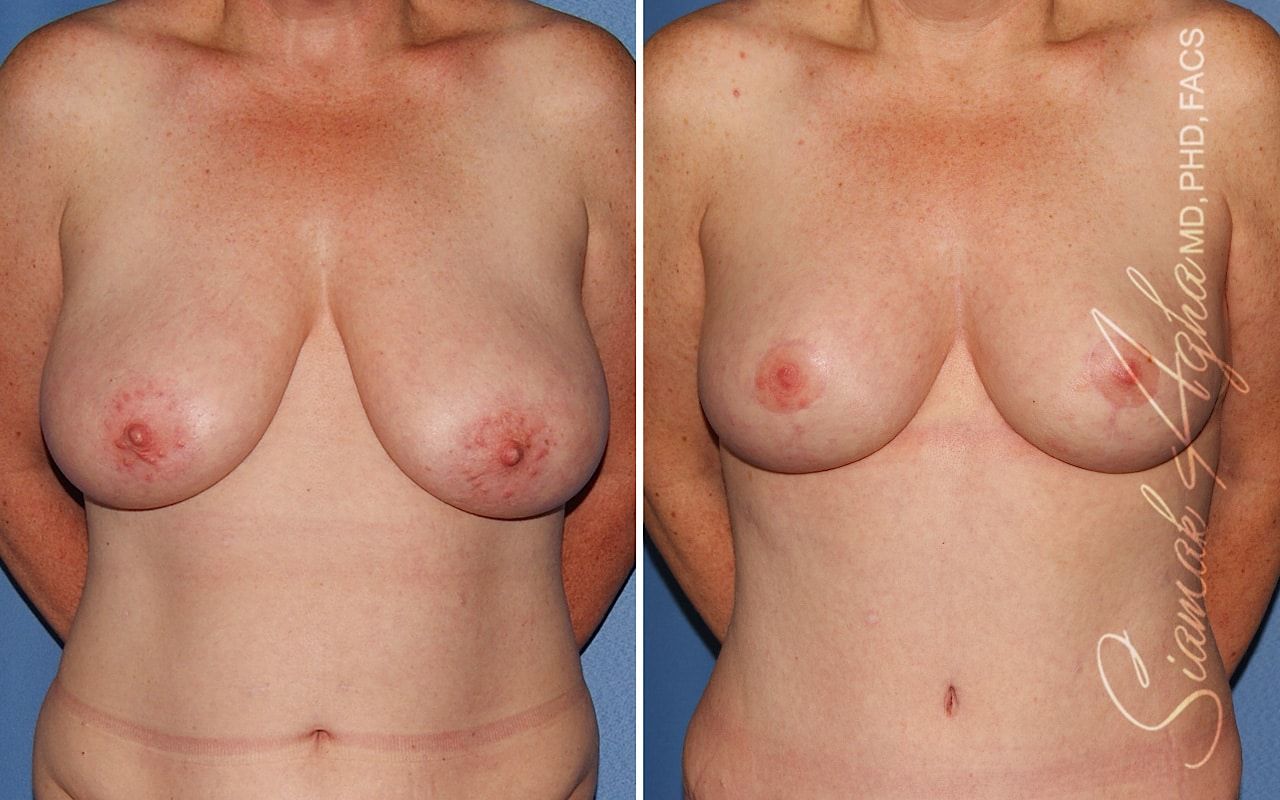 Breast Reduction Before & After