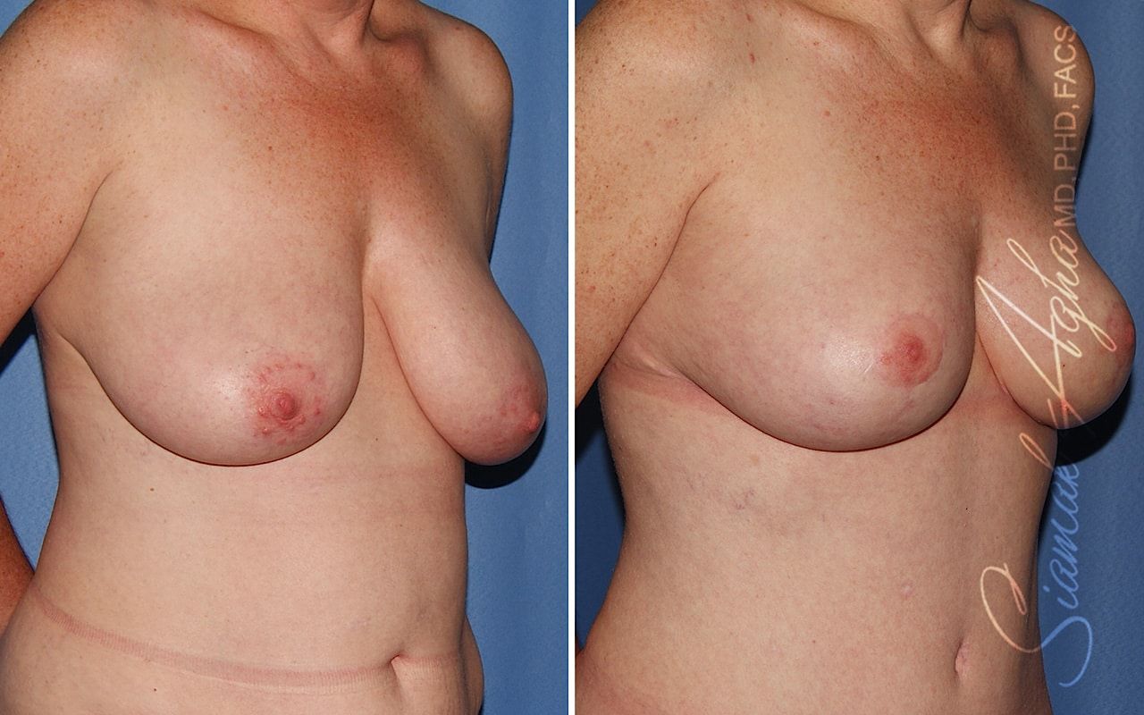 Breast Reduction Before & After