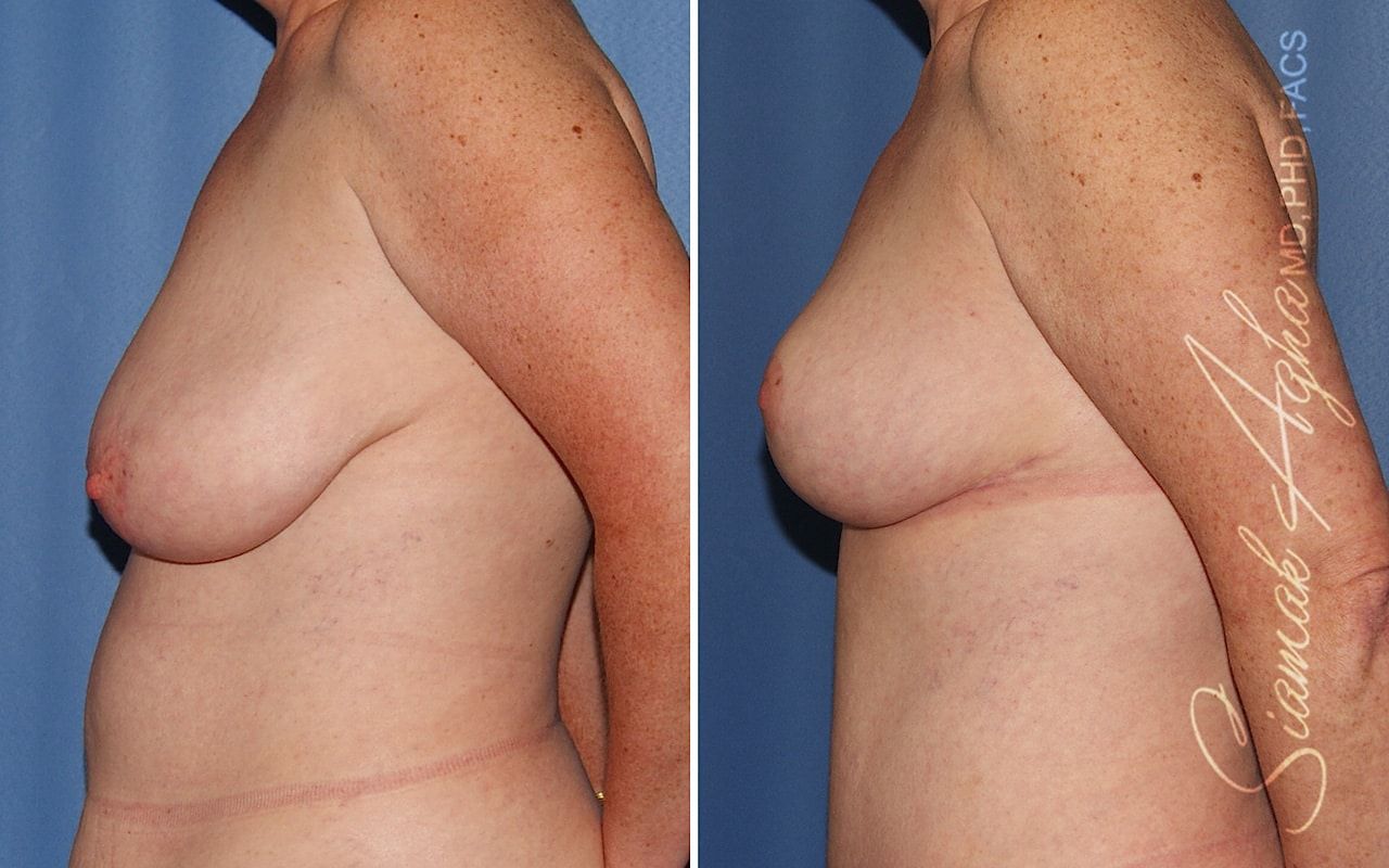 Breast Reduction Before & After