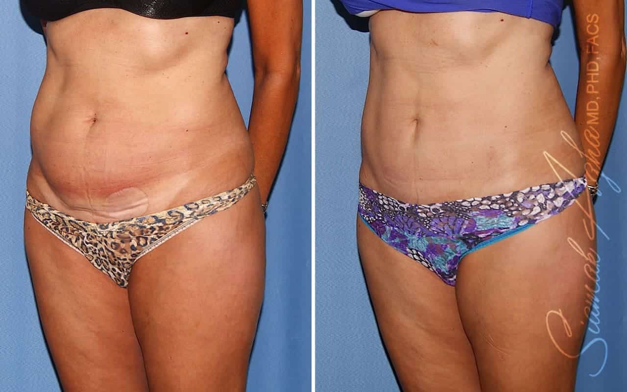 Mini Tummy Tuck Before & After