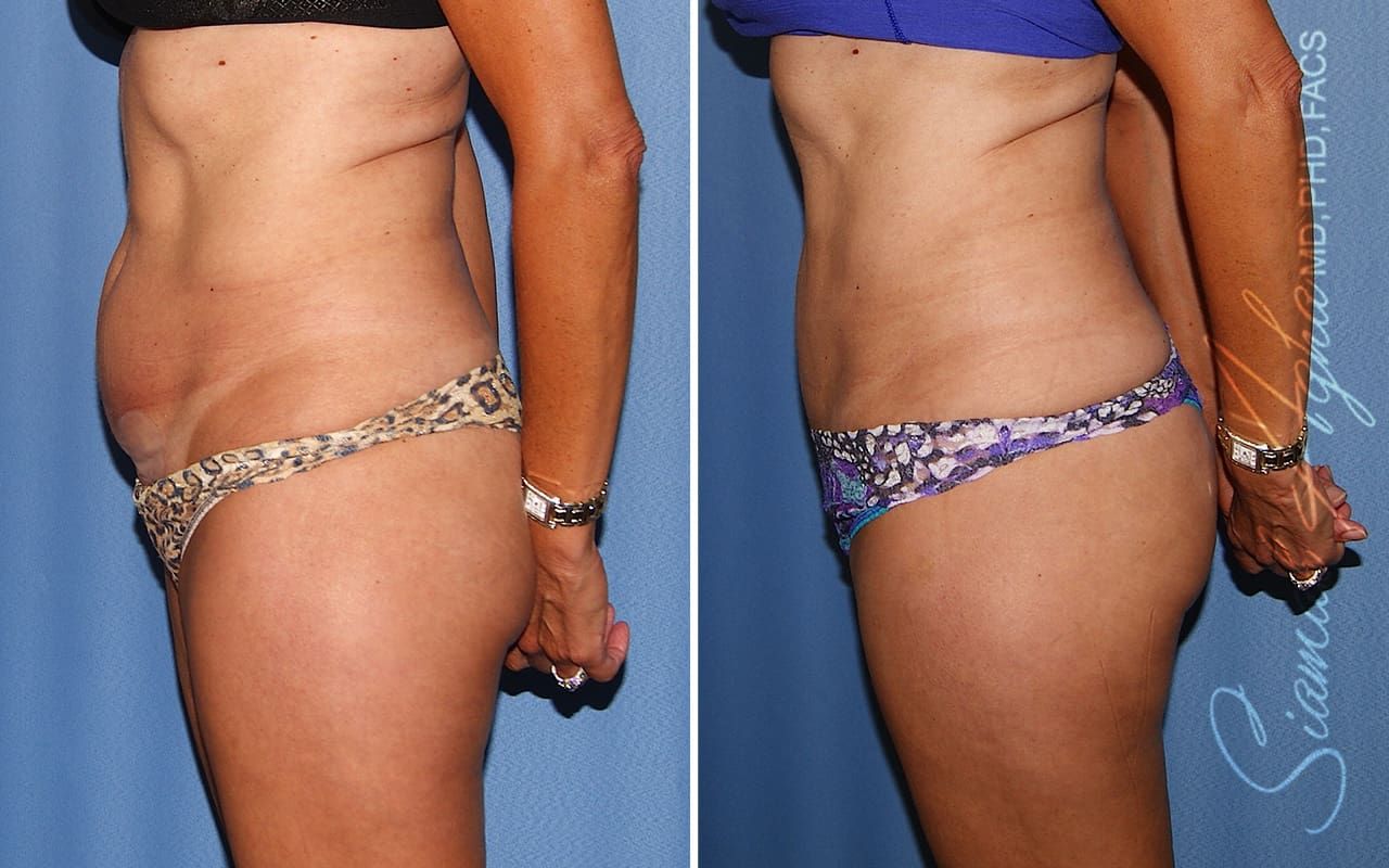 Mini Tummy Tuck Before & After