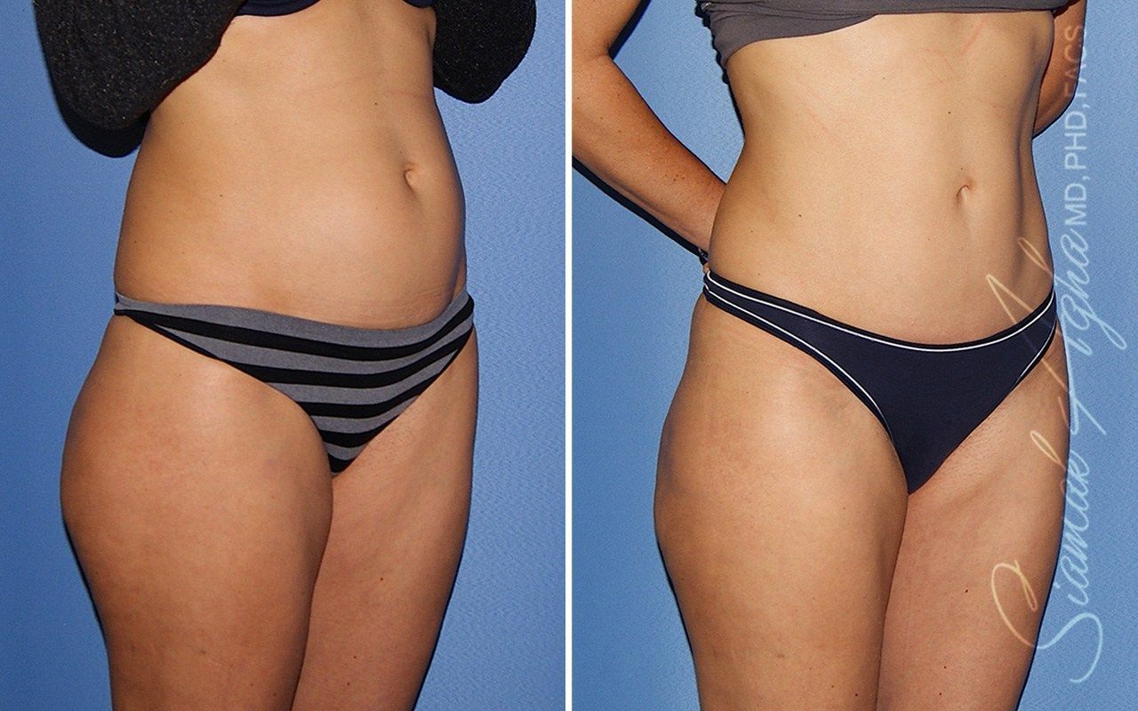 Mini Tummy Tuck Before & After