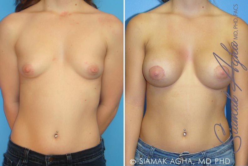 Tubular Breast Correction Before & After