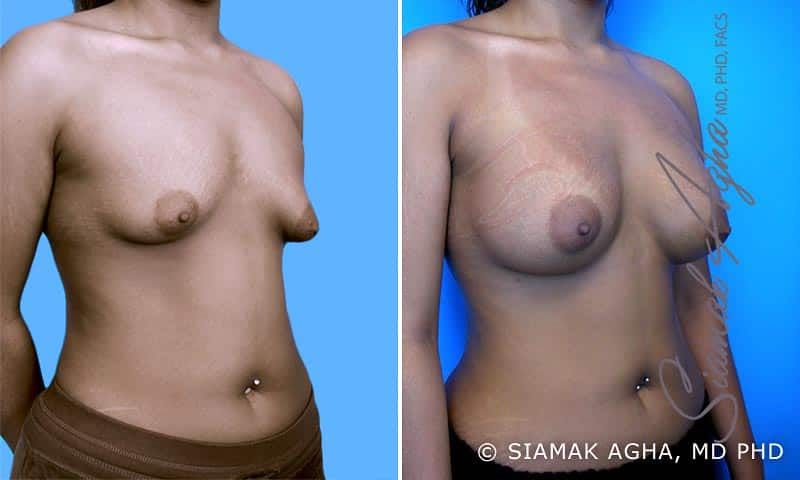 Tubular Breast Correction Before & After