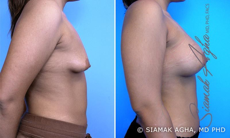 Tubular Breast Correction Before & After