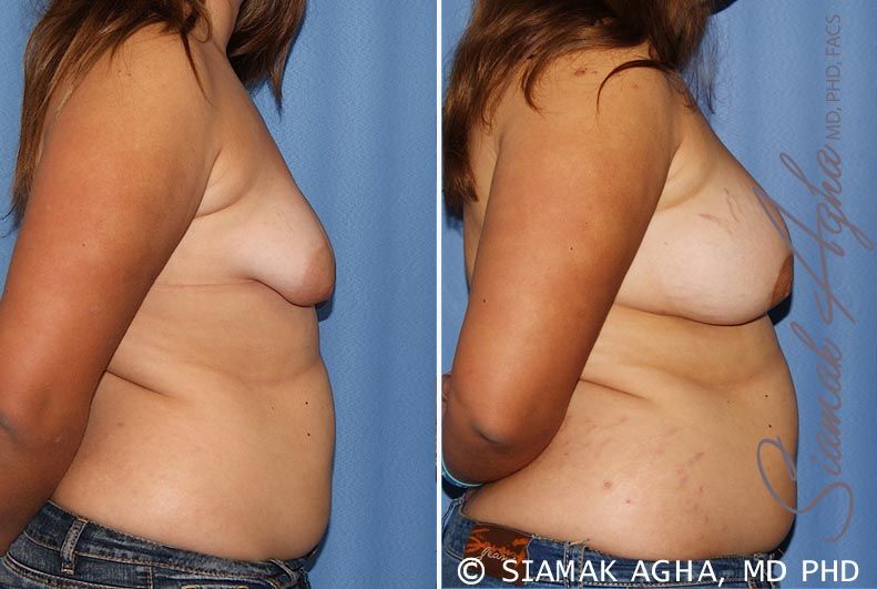 Tubular Breast Correction Before & After