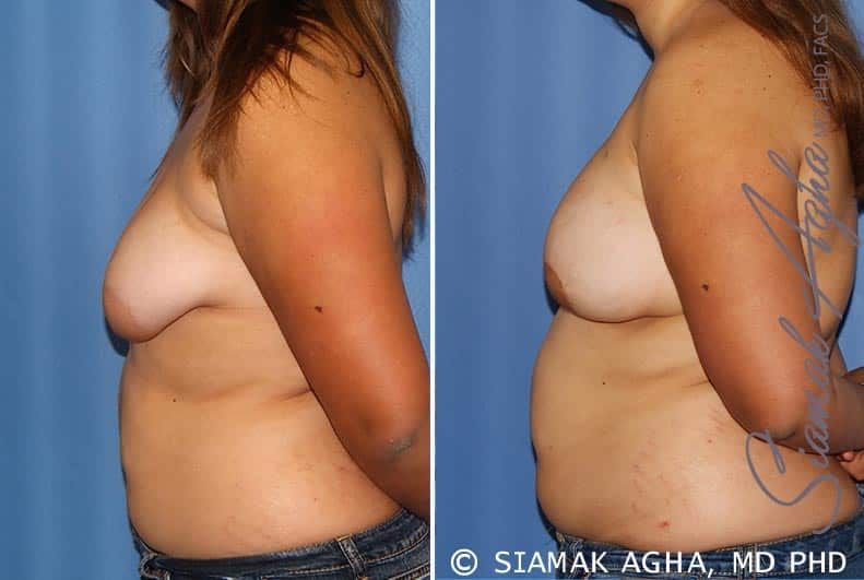 Tubular Breast Correction Before & After