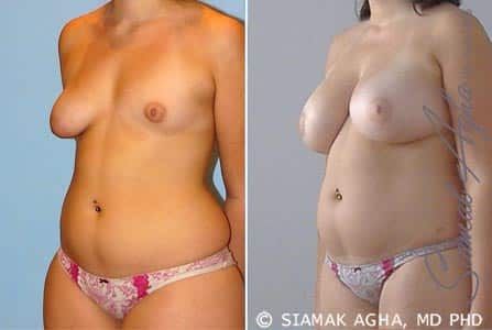 Tubular Breast Correction Before & After