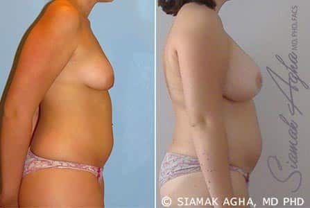 Tubular Breast Correction Before & After