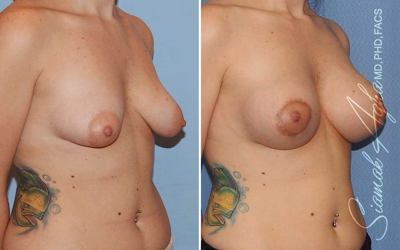 Tubular Breast Correction Before & After