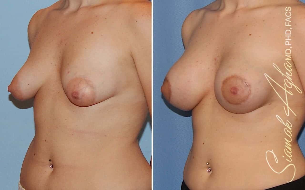 Tubular Breast Correction Before & After
