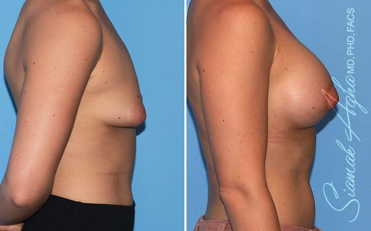 Tubular Breast Correction Before & After