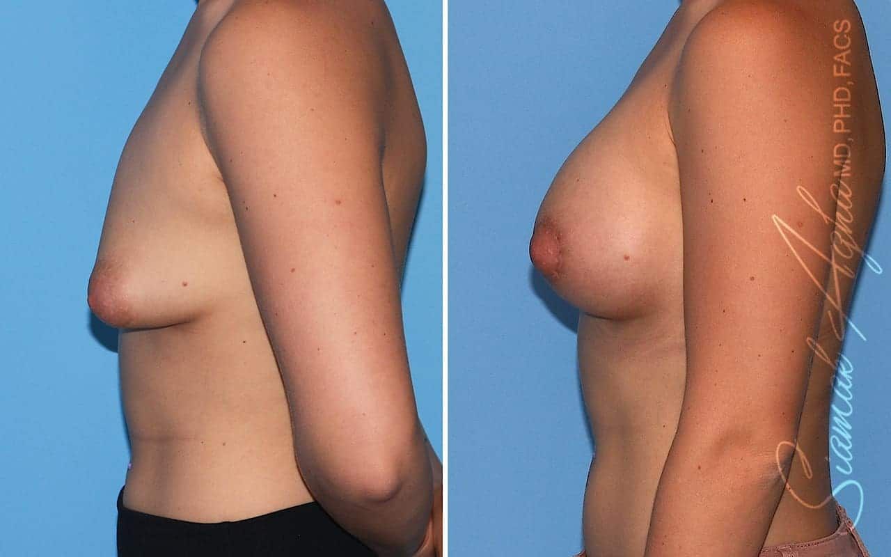 Tubular Breast Correction Before & After
