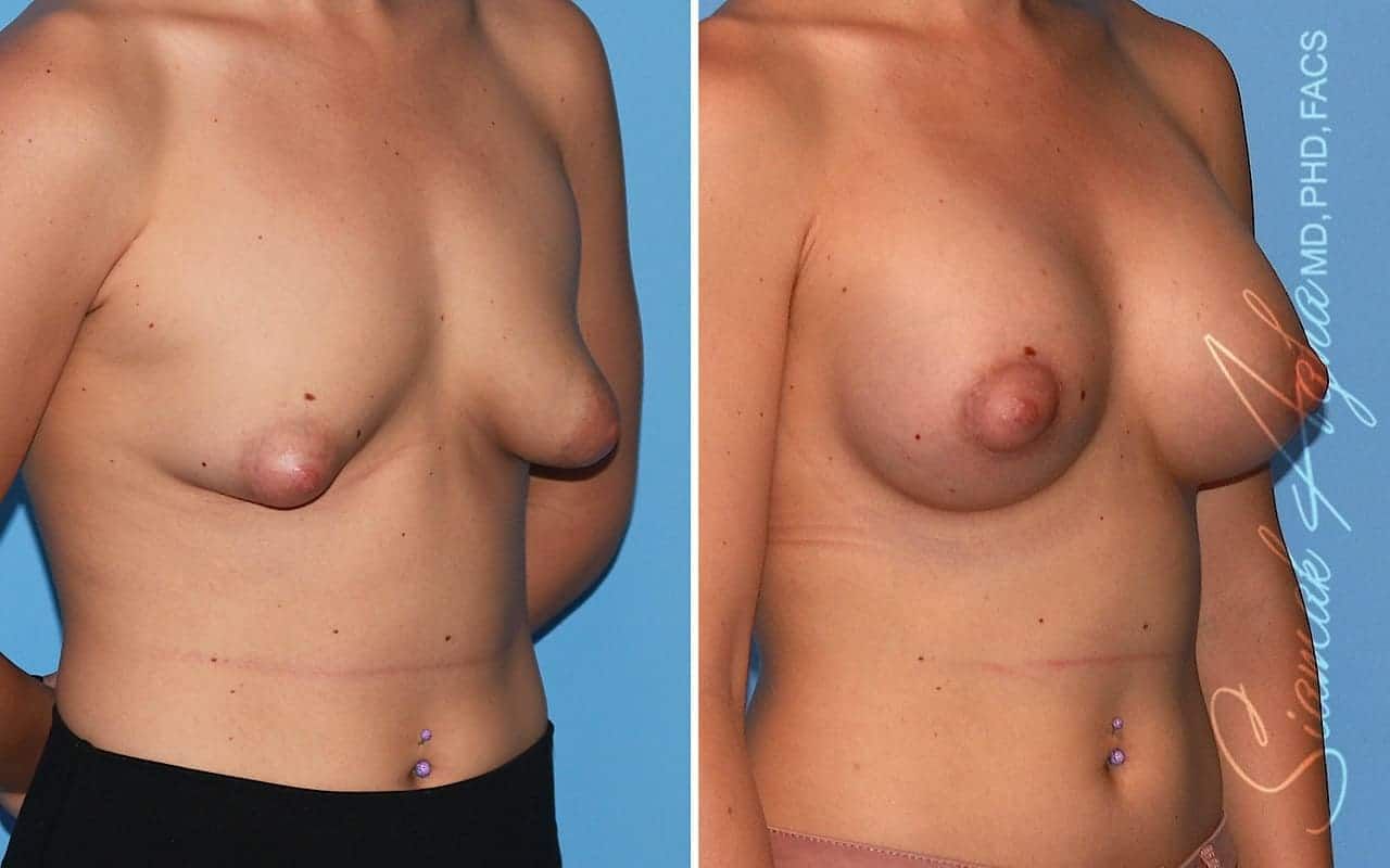 Tubular Breast Correction Before & After