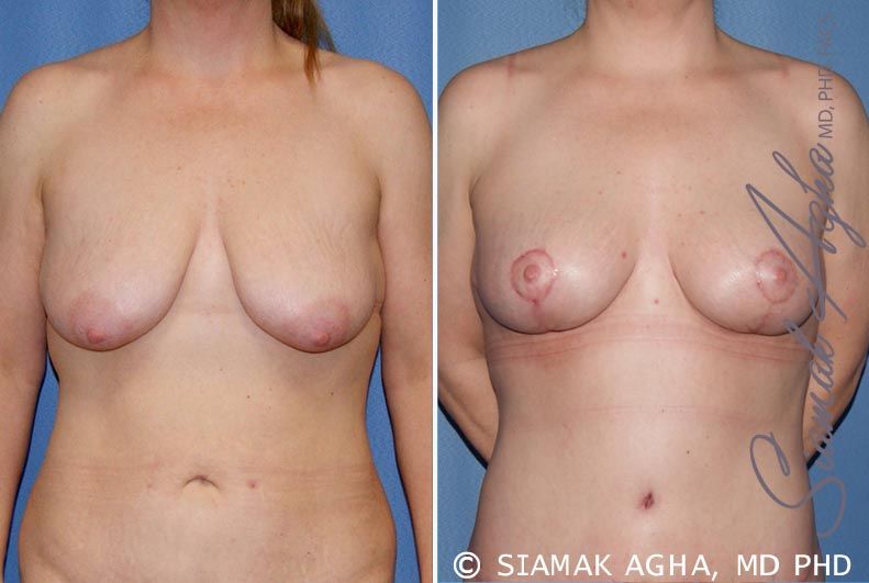 Tubular Breast Correction Before & After