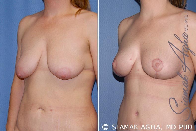 Tubular Breast Correction Before & After