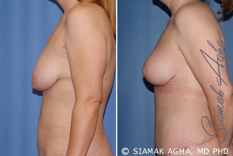 Tubular Breast Correction Before & After