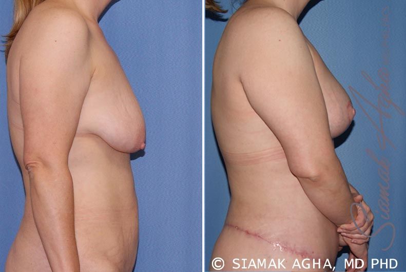 Tubular Breast Correction Before & After