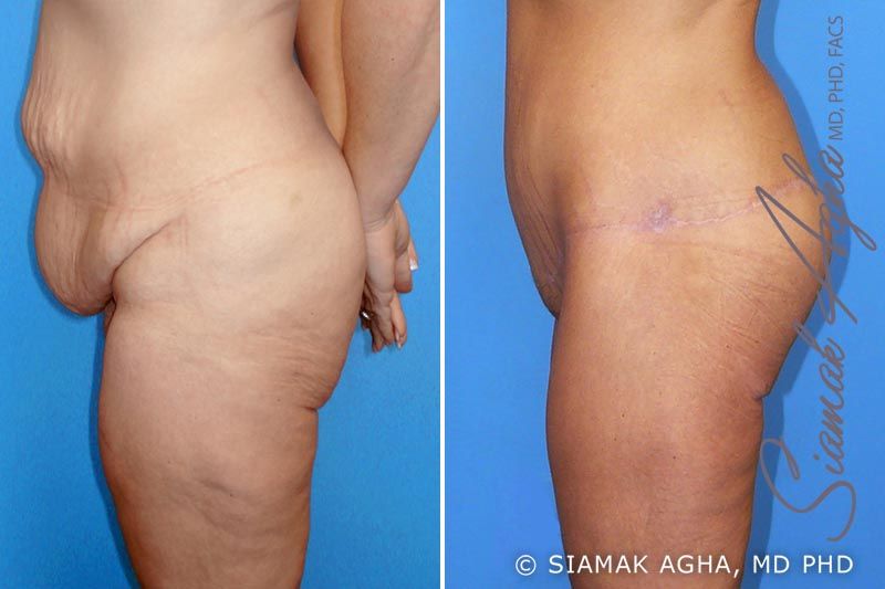 Lower Body Lift Before & After